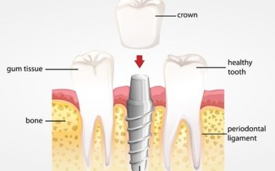 Repair and Improve Your Smile with Dental Implants