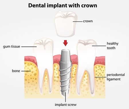 Repair and Improve Your Smile with Dental Implants