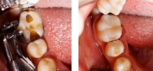 Composite Filling | Smith and Cole Dentistry