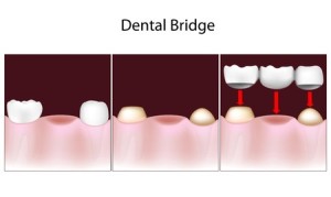 Dental Bridges | Smith and Cole Dentistry