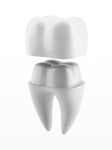 Dental Crowns | Smith and Cole Dentistry
