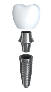 Dental Implants | Smith and Cole