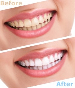 Teeth Whitening | Smith and Cole Dentistry