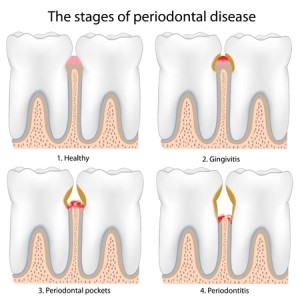 Periodontal Disease | Smith and Cole Dentistry