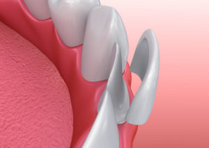 Porcelain | Smith and Cole Dentistry