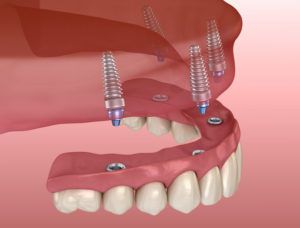 implant supported dentures